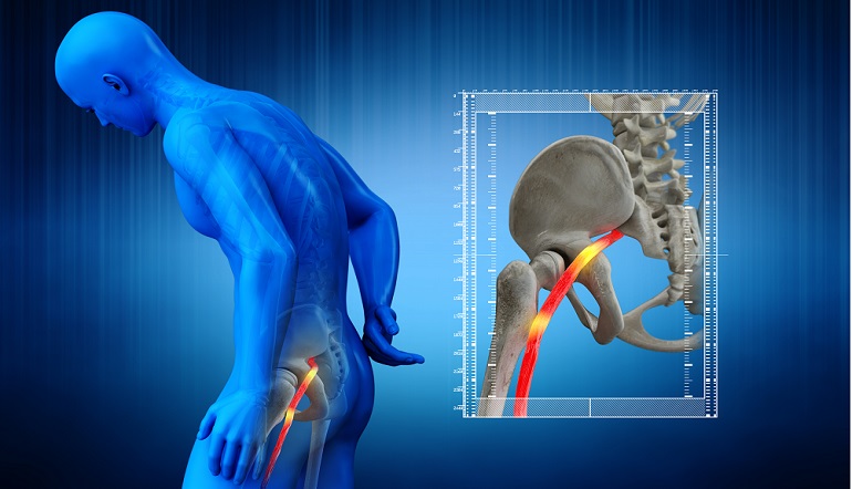 Sciatica Pain Relief Using Virtual Reality Therapy